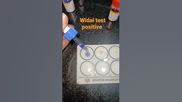 Serological practical WIDAL test #typhoidfever #trending #practical #pathology #shorts