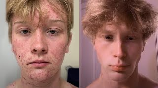 How to ACTUALLY Lose Face Fat (No Bullsh*t Guide) 2025