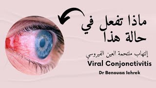ماذا تفعل في حالة إلتهاب ملتحمة العين الفيروسي
