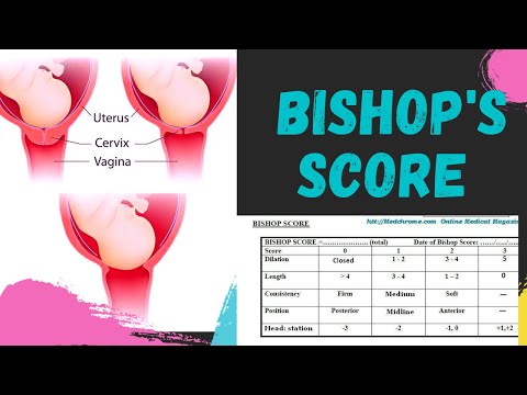 Video: Bishop Score: Čo Je To A Ako To Ovplyvňuje Riziko Indukcie?