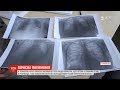 Троє людей померли через пневмонію у Тернополі