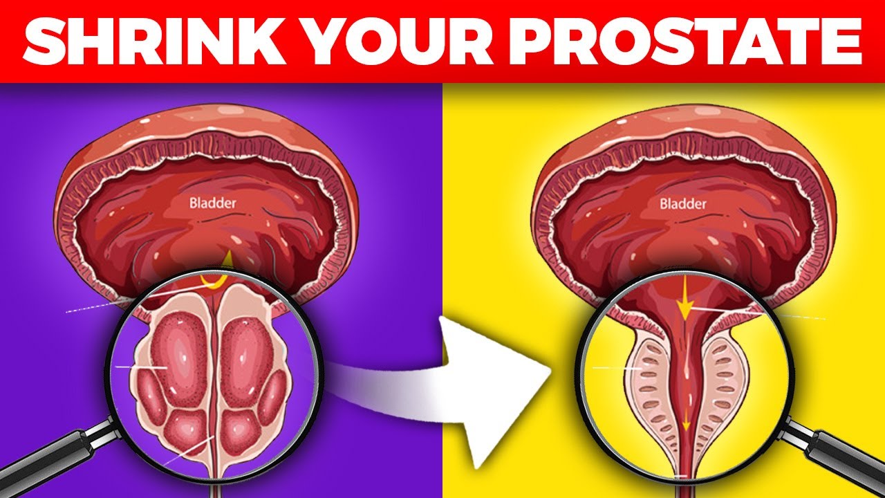 What foods help shrink the prostate