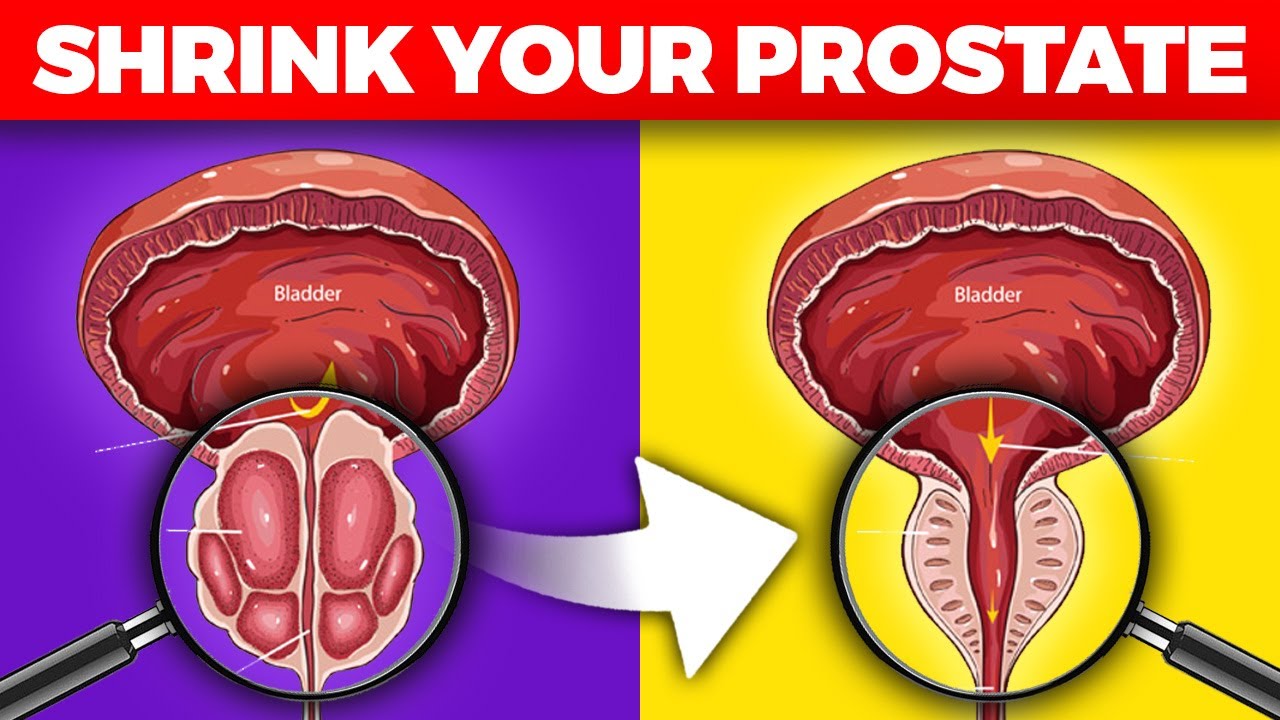 The #1 Important Nutrient to Shrink Your Prostate