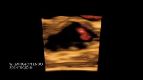 3DTHYROID® Thyroid Nodule 3