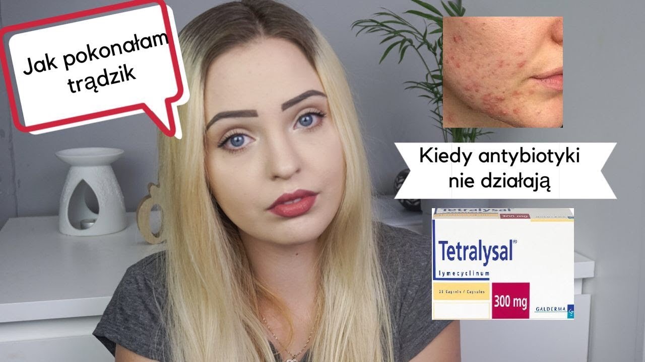 Jak wyleczyłam trądzik I Moja historia...