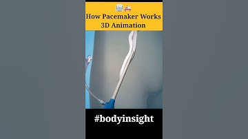 how Pacemaker Works #bodyinsight #shortsfeed