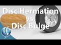 Herniation vs Bulge