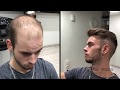 Hair replacement fitting david part 2  hair inspira