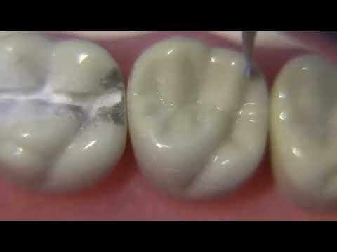 تراش حفره ترمیم آمالگام  بر روی دندان های مولر اول مندیبل و ماگزیلا