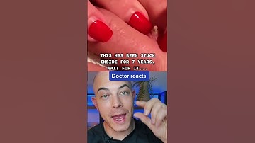Thumbnail of Doctor reacts to a crazy foreign body removal! #foreignbody #dermreacts #splinter