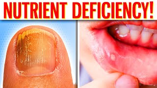 The 10 Hidden Signs Of Nutrient Deficiency You Should Never Ignore