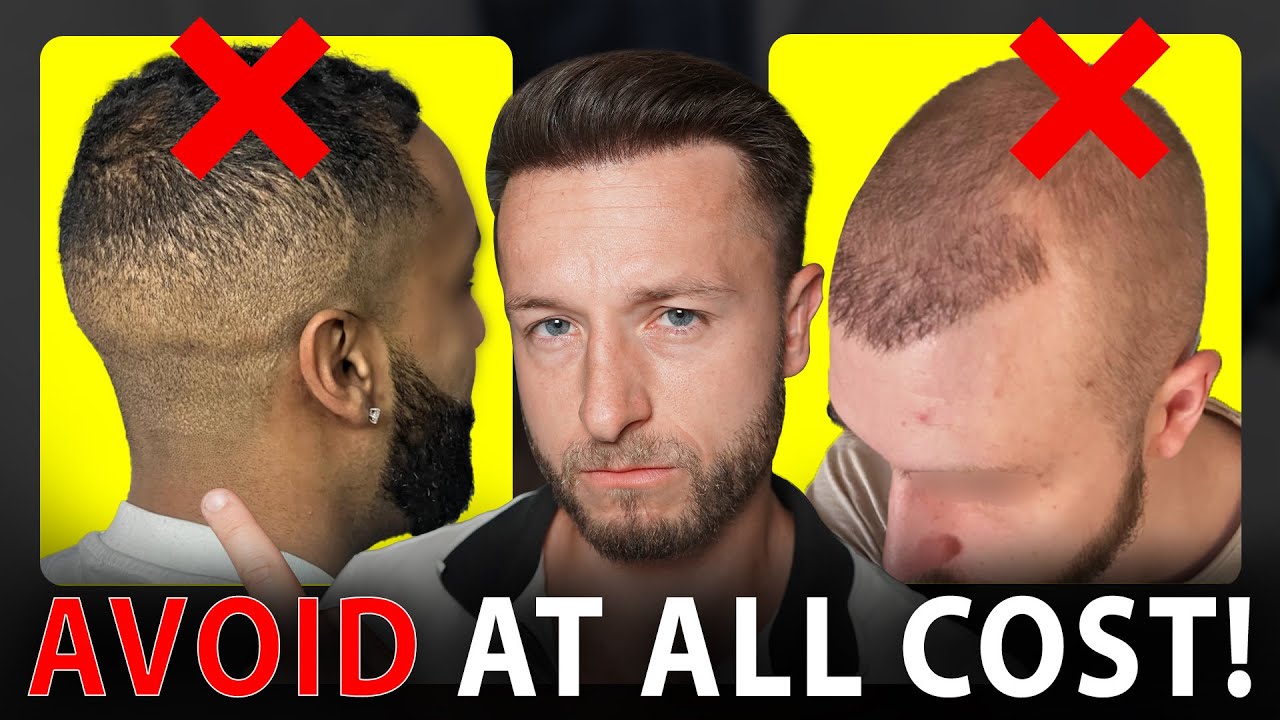 5 Common Hair Transplant Failures To Avoid! + Real Fixes