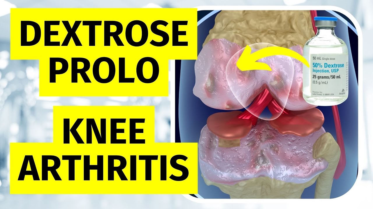 Dextrose Prolotherapy for Knee Pain YouTube