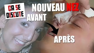 Chirurgie esthétique : elle pleure en voyant son nouveau nez ! - Ça se discute