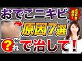 おでこにきび(額ニキビ)の原因と対処法は?ニキビ跡を残さない適切な治療法について皮膚科医が解説!