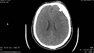 CASE 955 CT BRAIN Hyperostosis Frontalis Interna