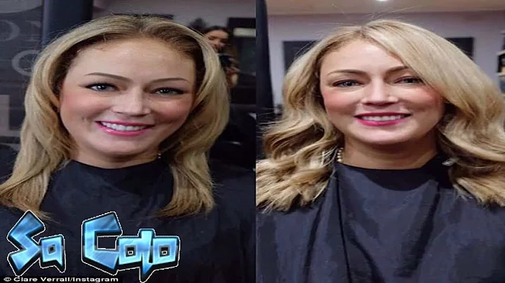 Clare Verrall revealed her dramatic hair loss is d...