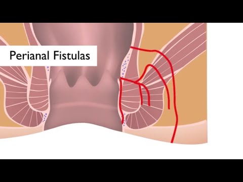 Video: Este fistulă sau fistule?