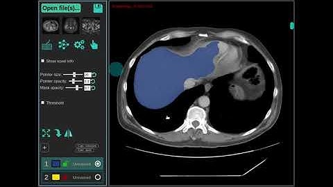 Automatic liver segmentation on selected slices with deep learning (CT).