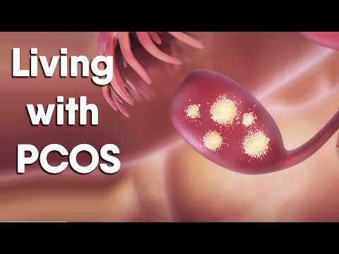 PCOS: Why It Happens and What You Can Do