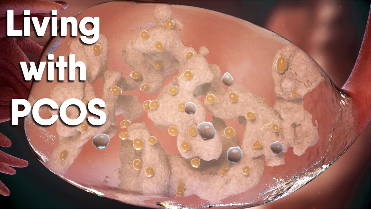 PCOS: Why It Happens and What You Can Do