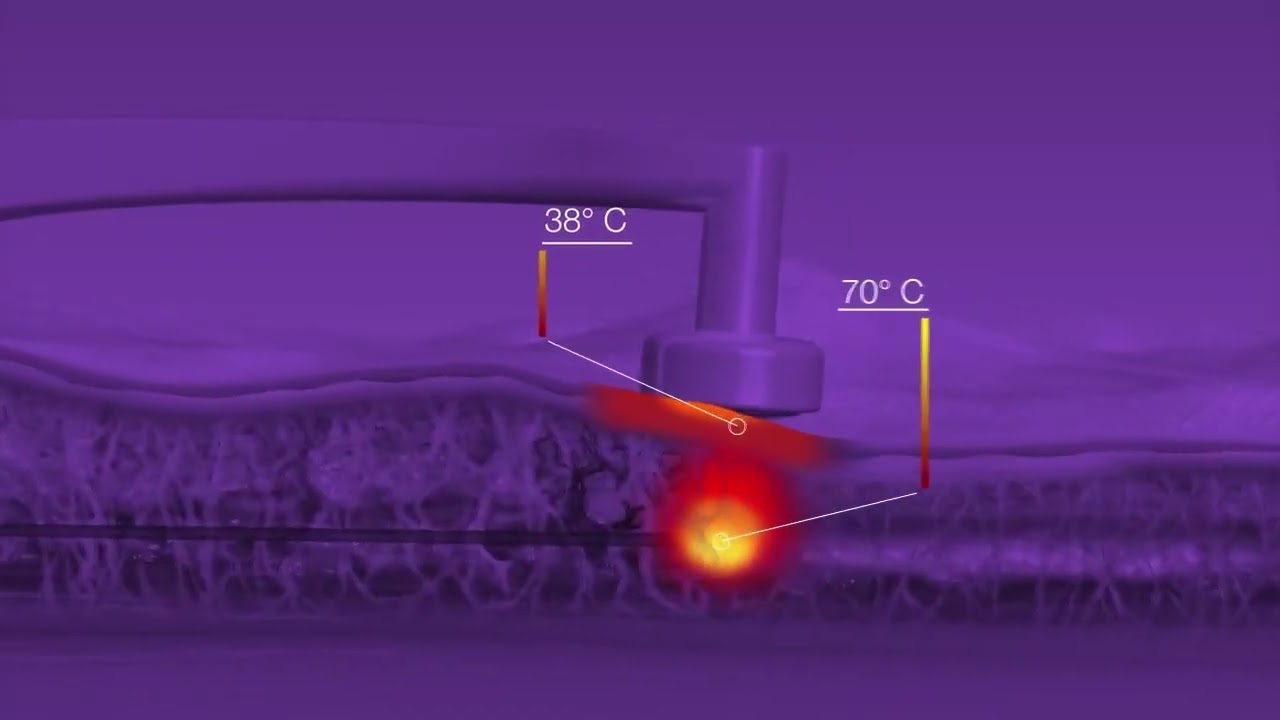 BodyTite Tunisie - remodelage du visage et corps sans chirurgie