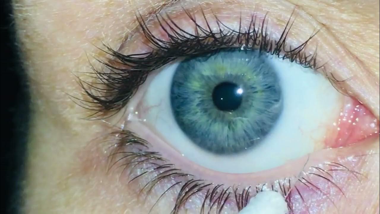 Eye mucous fishing syndrome YouTube