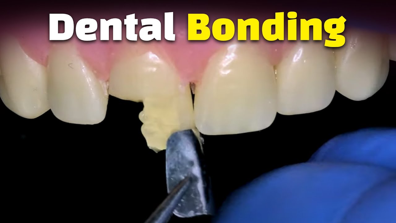 Teeth Recontouring and Shape Perfecting by direct composite bonding. (Teeth whitening )