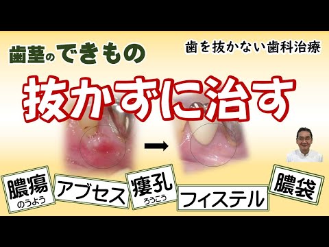 歯茎のできものは、膿瘍、アブセス、フィステル、ろう孔、膿の袋などと呼ばれます。