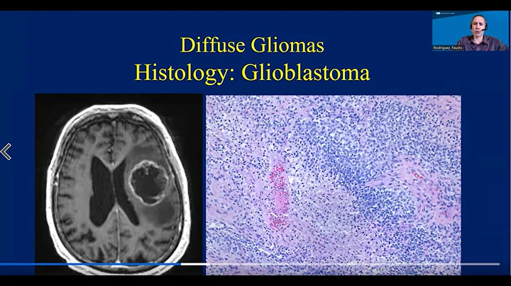 Understanding Neuropathology: UCLA Brain Tumor Virtual Conference