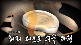 [명의 의학백과📖]  허리 디스크 수술 과정