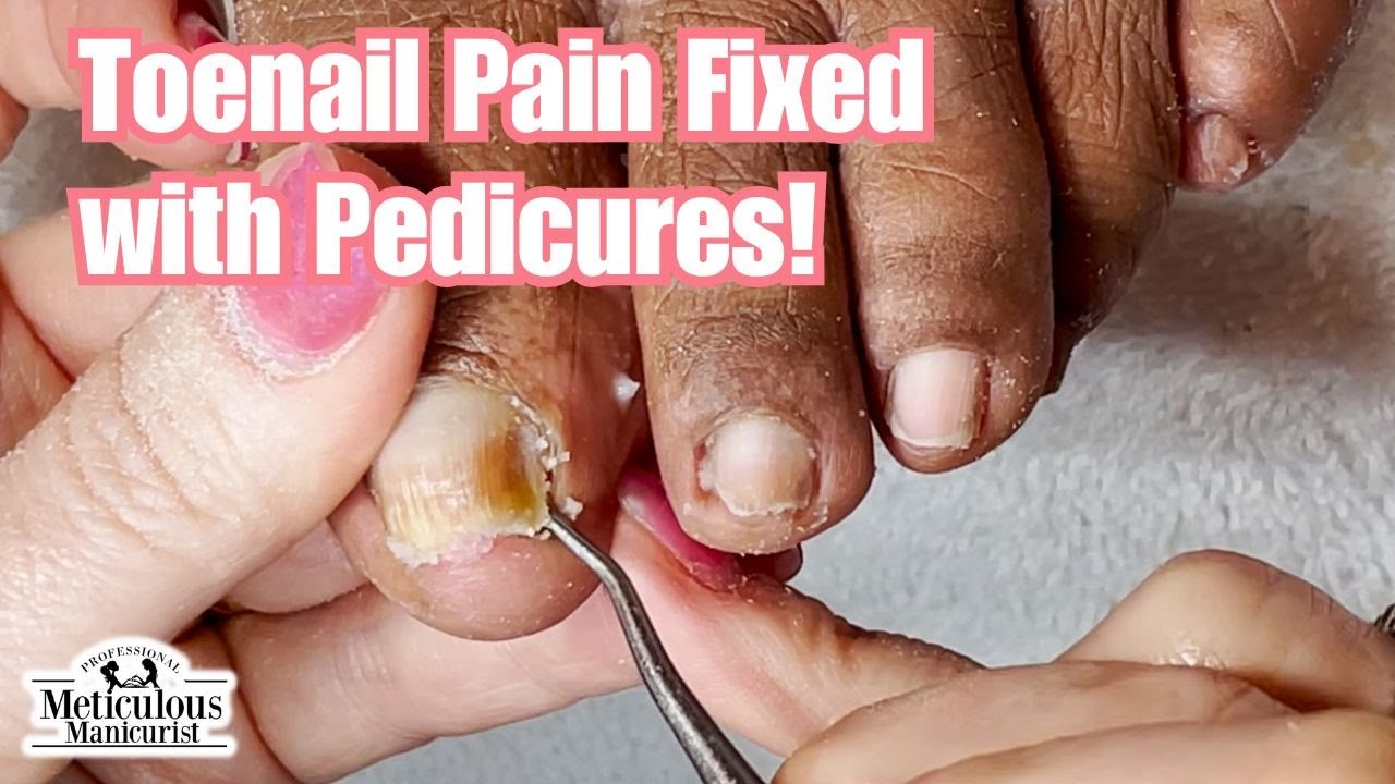 Livermore Podiatry - Conditions : Toenail Fungus