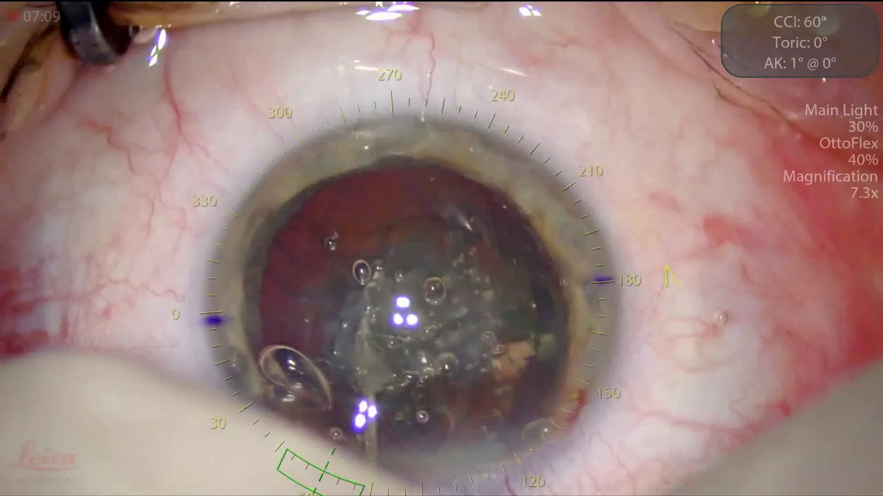 Laser cataract surgery using Catalys laser in eye with foldable