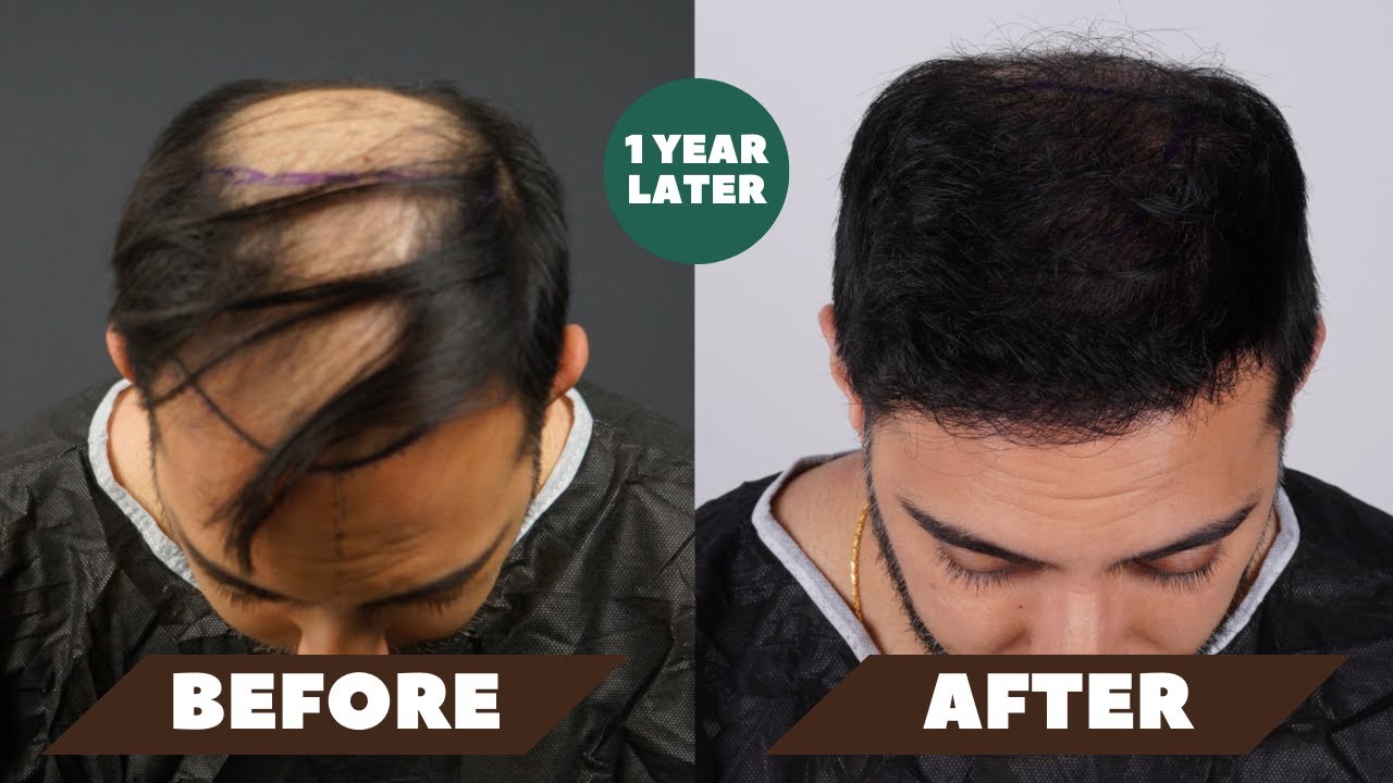 My 1 Year Hair Transplant Journey - Before & After (Trust The Process)