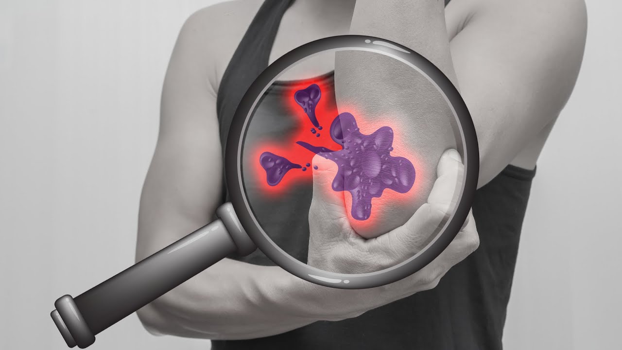 Kemik kanseri (tümörü) tedavisinde uzuv kaybı olur mu? | Prof. Dr. Yakup YILDIRIM