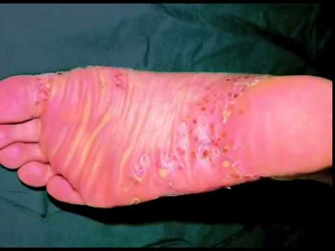 ფსორიაზის ტიპები და გამოვლინება - Types of Psoriasis   An Overview