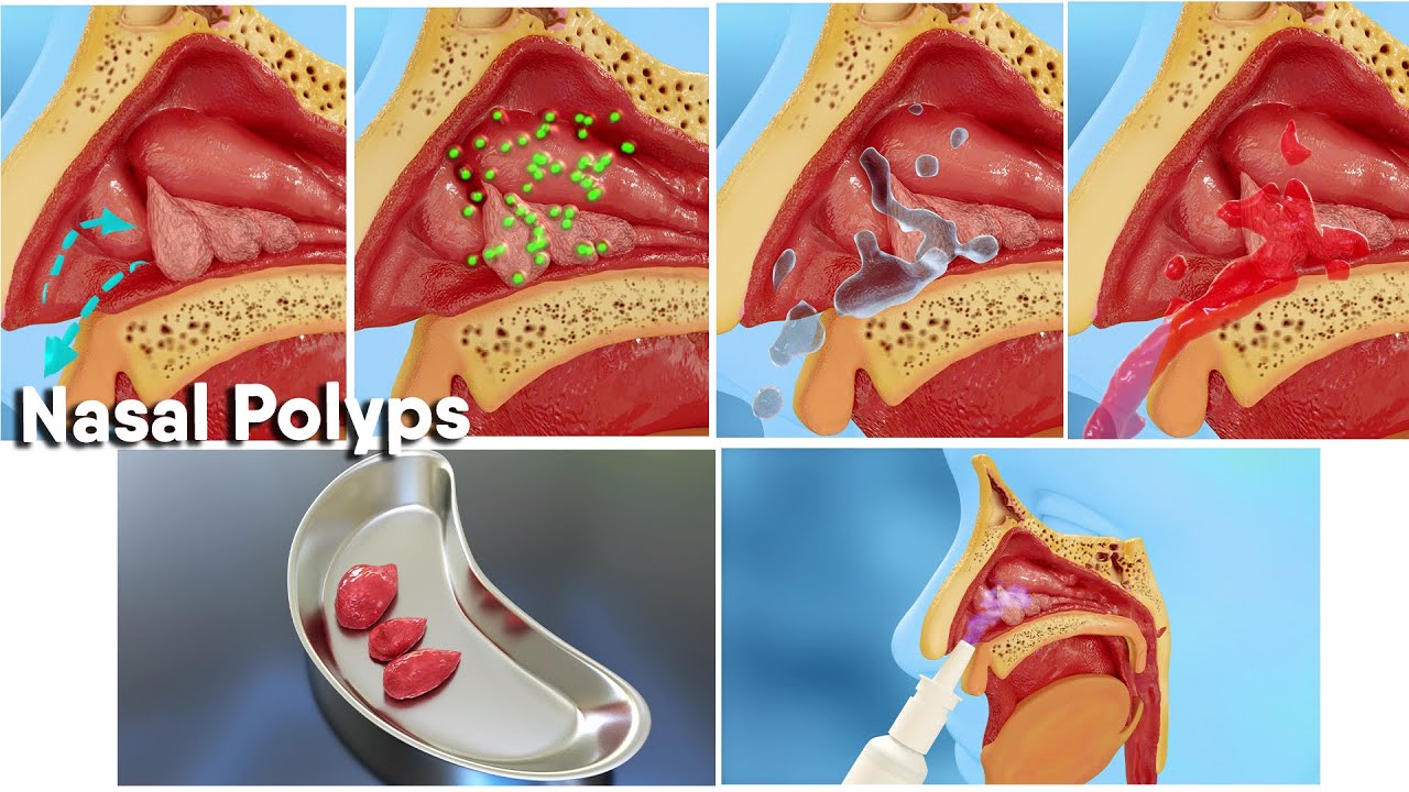 ⁣Nasal polyps treatment and surgery! 3d medical animation|Dandelion Team #nasalpolyp #noose