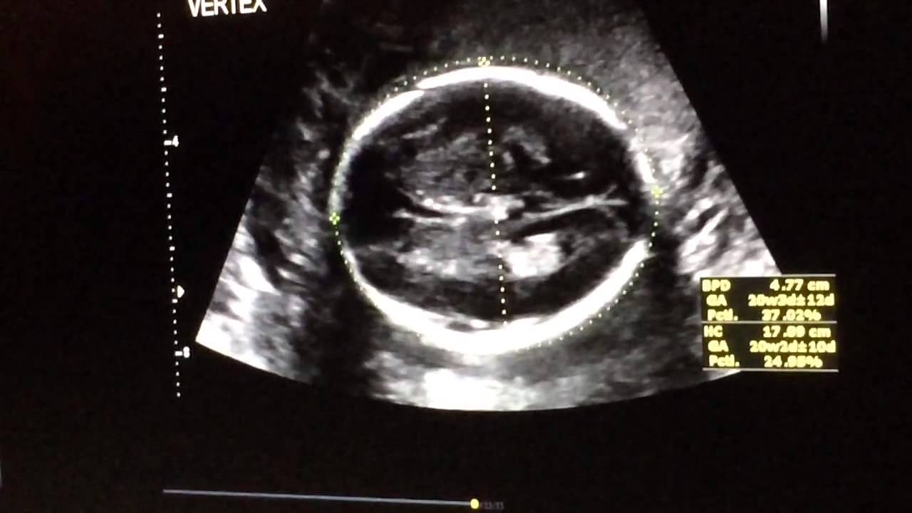 20 Week Anatomy Ultrasound Part 4 YouTube 20 Week Anatomy Ultrasound Part 4 YouTube