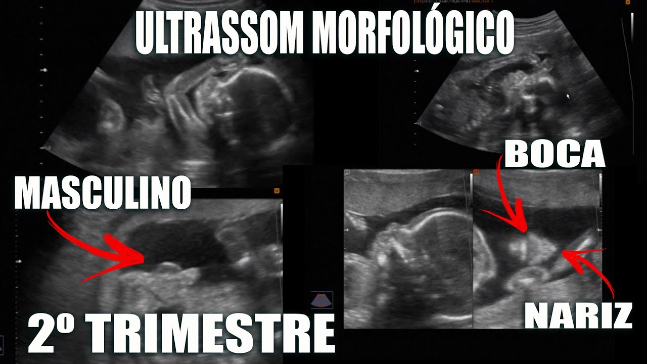 ULTRASSOM MORFOLÓGICO - 2º TRIMESTRE - 20 SEMANAS (Ella Leal) - YouTube
