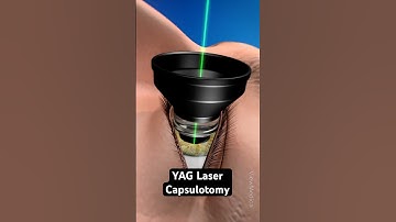 Clearing cloudy vision after cataract surgery (3D Animation)