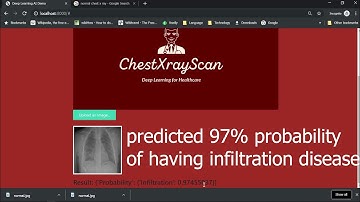 Lung Disease Prediction from Chest X Rays