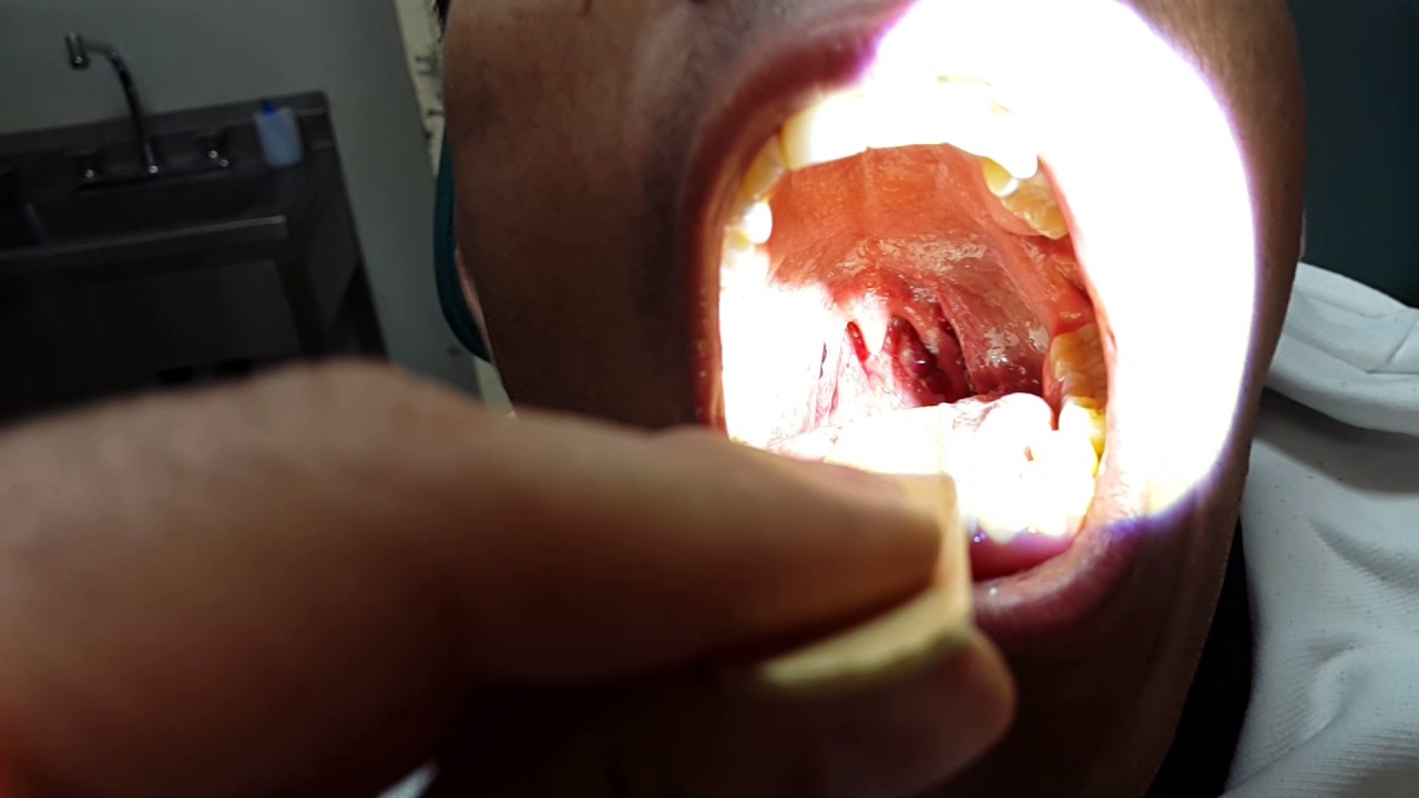 tumor de amigdala izquierda youtube tumor de amigdala izquierda youtube