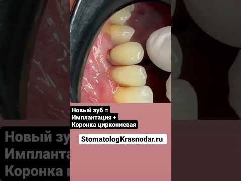 зубные протезы   коронки на передние зубы циркониевые- успешная имплантация
