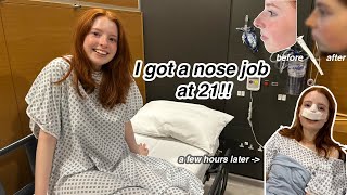 I GOT A NOSE JOB! my WHOLE rhinoplasty process - recovery + results, everything I bought to prepare!