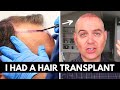 HAIR TRANSPLANT UK SURGERY | FUE 4000 GRAFTS | THE HAIR DR