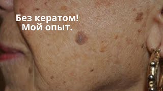 Без кератом. Мой опыт борьбы с пигментными пятнами и кератомами.