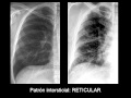 Patrones Radiológicos Básicos de la Radiografía de Tórax I