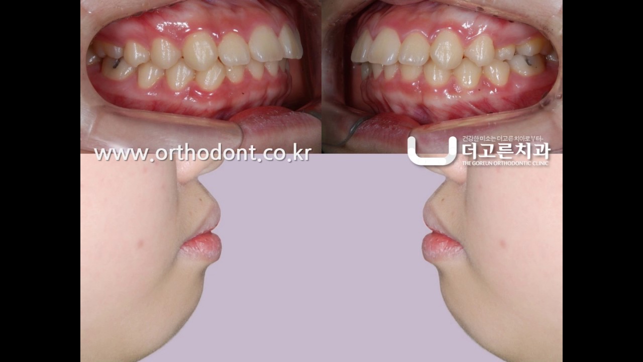교정치료를 통한 돌출입의 변화 (Changes in the protruding mouth through orthodontic treatment) YouTube