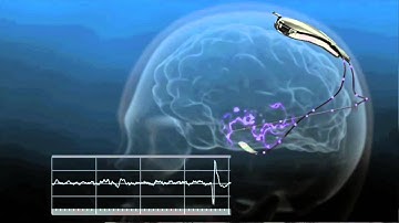 AggieChallengE Video-Epileptic Seizure Prediction Introduction