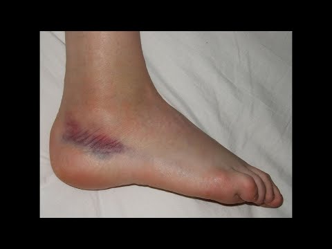 Video: Foot Injury: Home Treatment, Photo